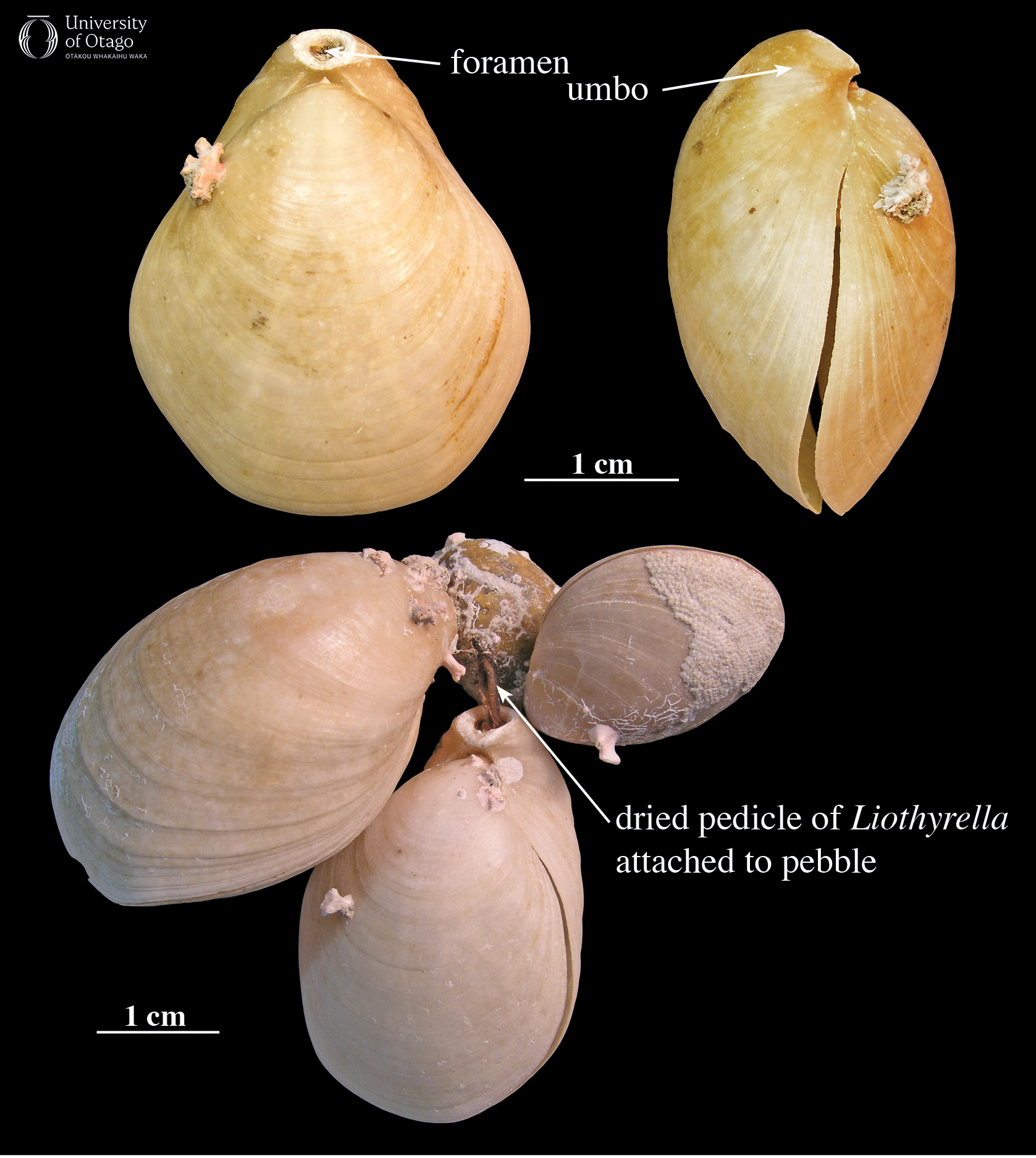 A visual guide to some of the terms used to describe brachiopods. The purpose of the figure is to show the foramen, which is an opening in one of the shells of the brachiopod, the umbo, which is a curved structure near the hinge between the two shells, and the presence of a pedicle or stalk, which is used by brachiopods to attach to a surface.