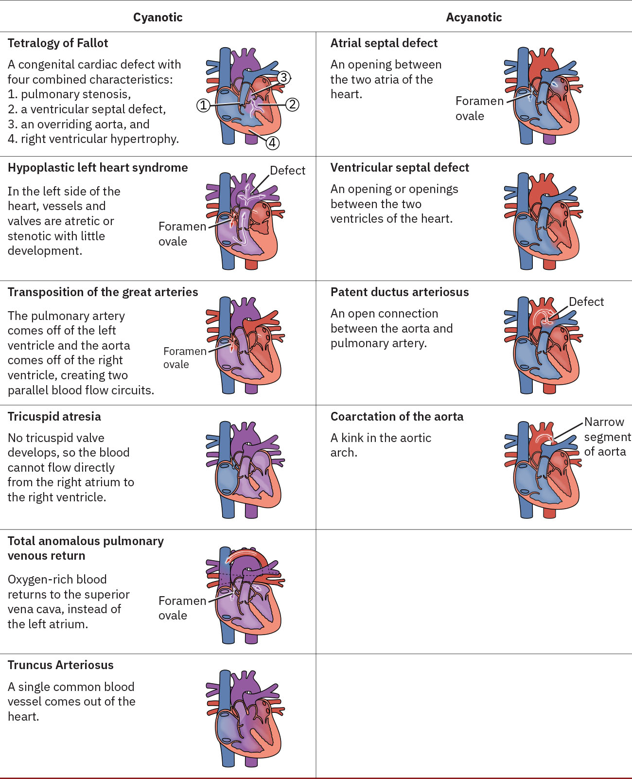 Congenital heart defects (CHD) occur in one in four live births and are among the most common congenital defects. Red blood denotes oxygenated blood, while blue blood shows venous return blood that has become deoxygenated. Purple blood shows mixing of both red and blue blood or mixing from the right and left sides of the heart.