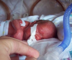 An intubated female premature infant born prematurely 26 weeks 6 days gestation, 990 grams. Photo taken at approximately 24 hours after birth