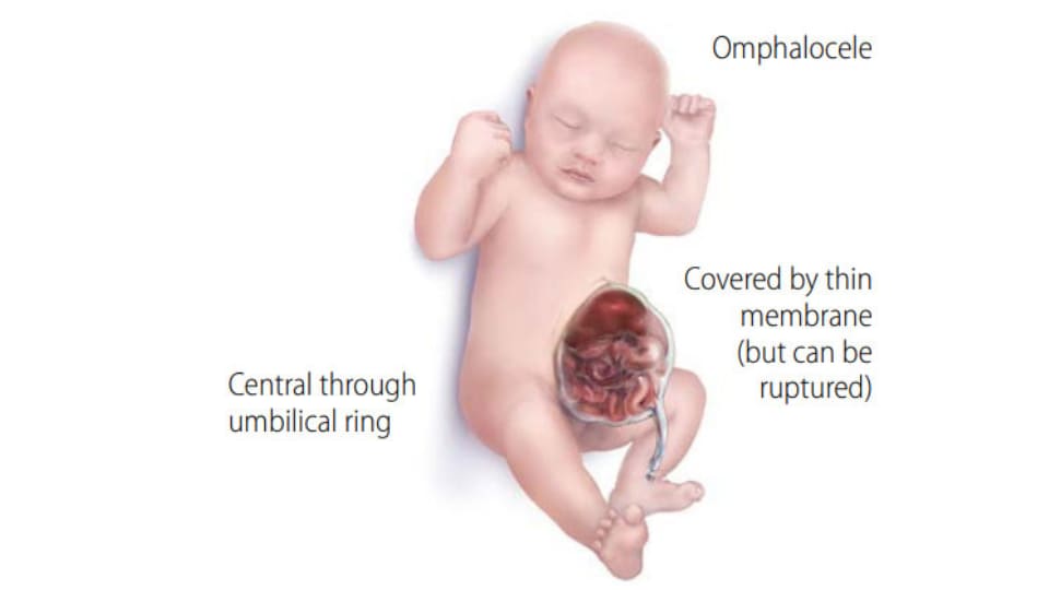 Infant with Omphalocele