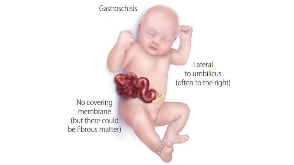 Infant with Gastroschisis