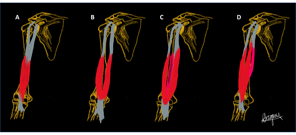 Four phenotypes of biceps brachii variation.