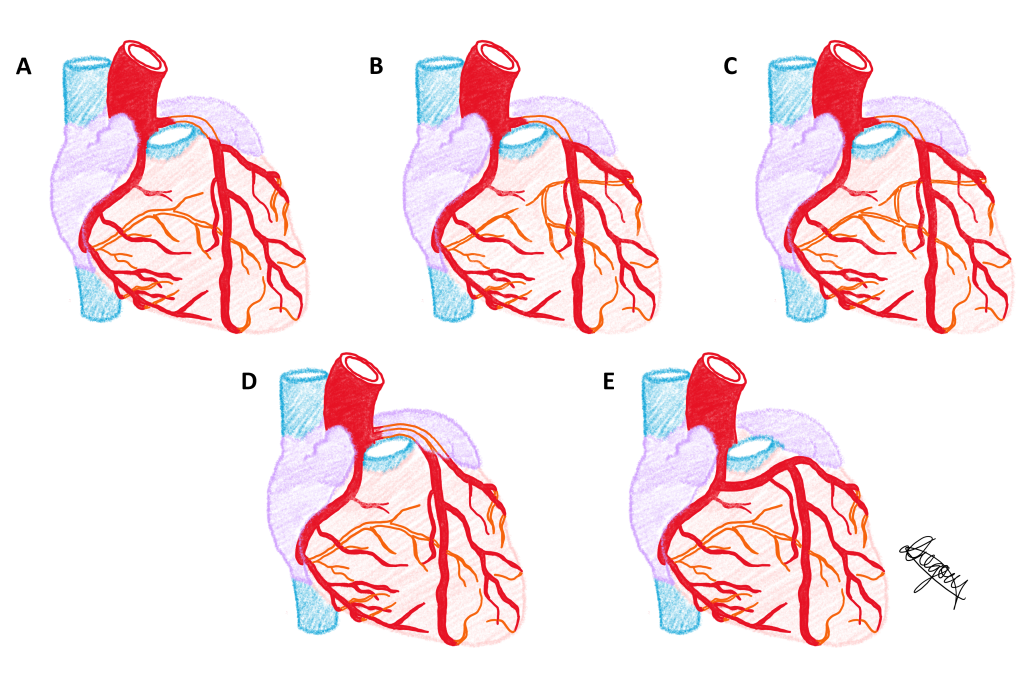 The same five phenotypes of the coronary arterial circulation are presented in a single diagram.