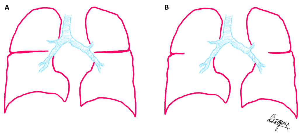 Coronal view of right and left lungs. Two example phenotypes of the anatomical variation of the depth of lung fissures.