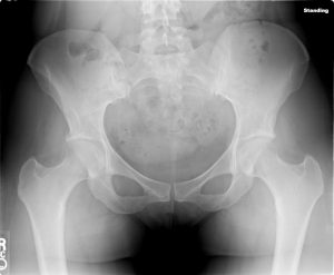 X-ray of female pelvis