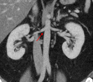 Coronal image of abdomen with right renal artery angle of origin highlighted.