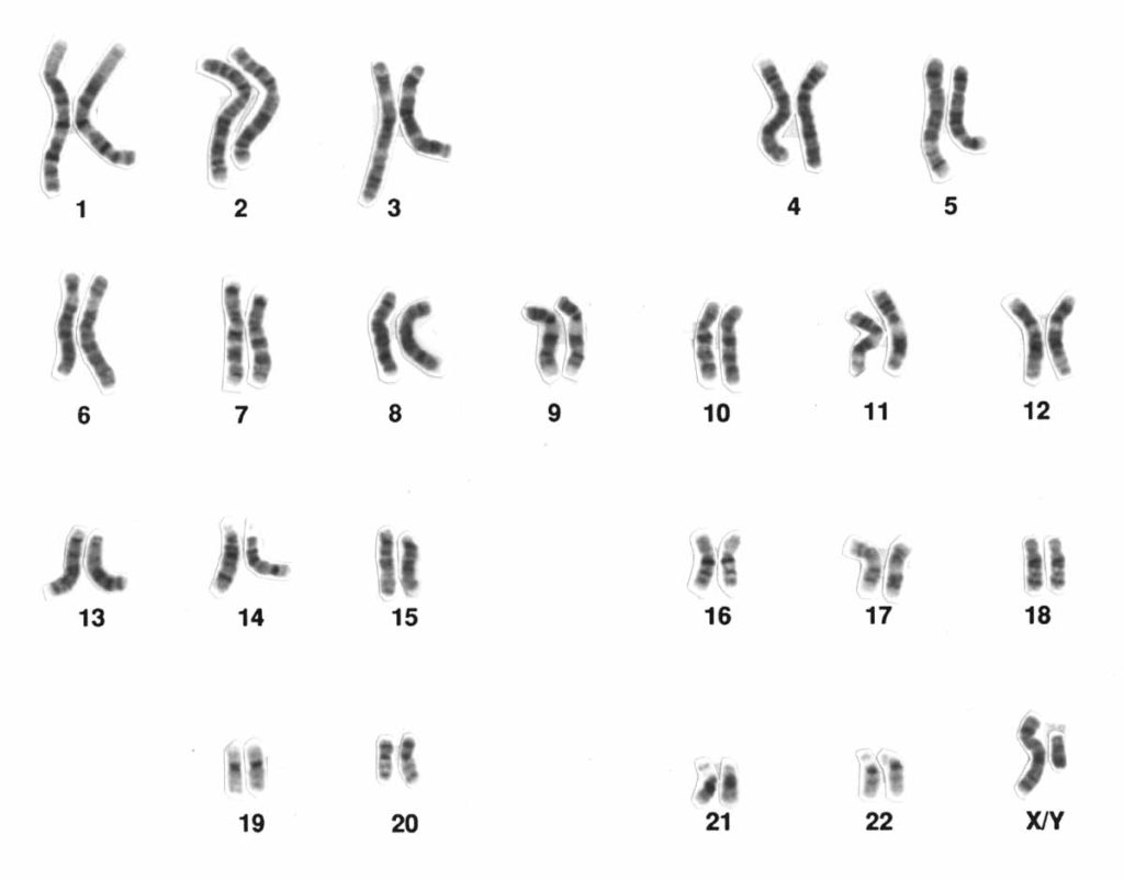 Actual chromosomes which have been stained with Giemsa staining, producing visible banding patterns on each chromosome and laid out in size order to produce a complete karyogram of the individual.