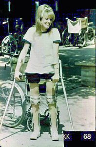 Girl standing on crutches with calipers on her legs. Wearing shorts, a t-shirt and a ribbon in her hair.