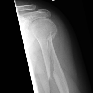 Xray of proximal spiral humeral fracture
