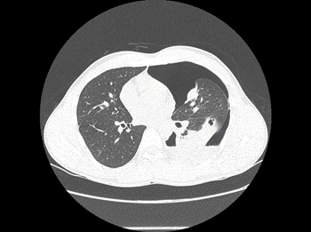 Chest CT scan