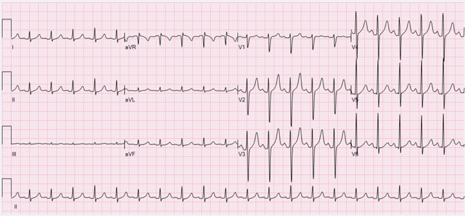 Facsimile of an ECG printout