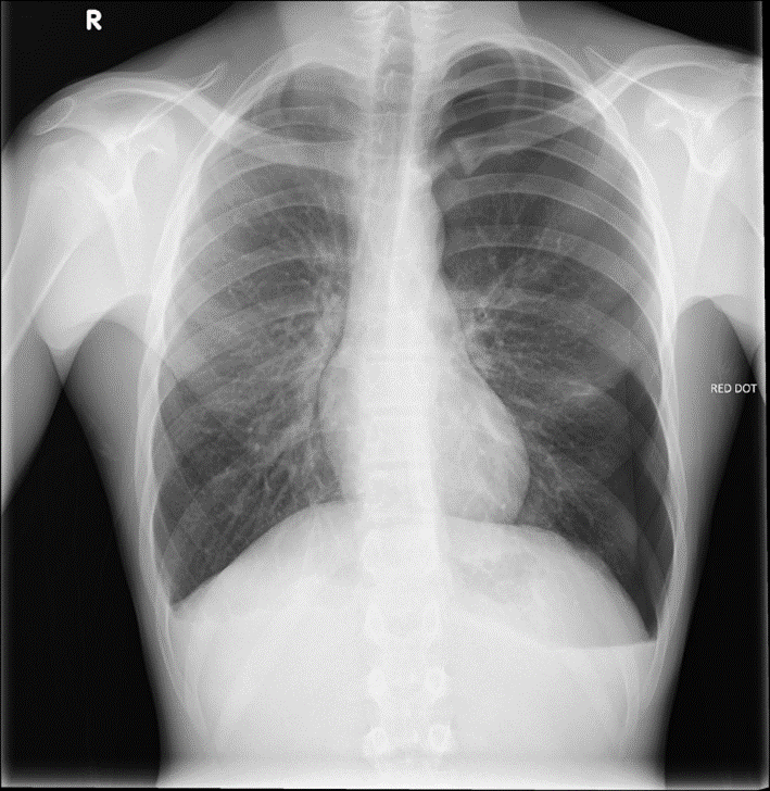 Chest x-ray