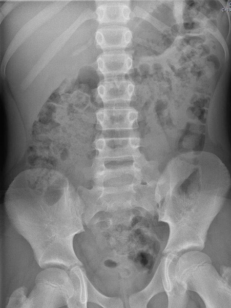 Abdominal x-ray