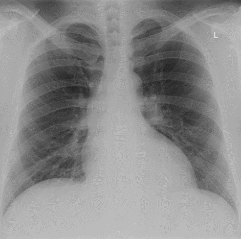 Chest x-ray