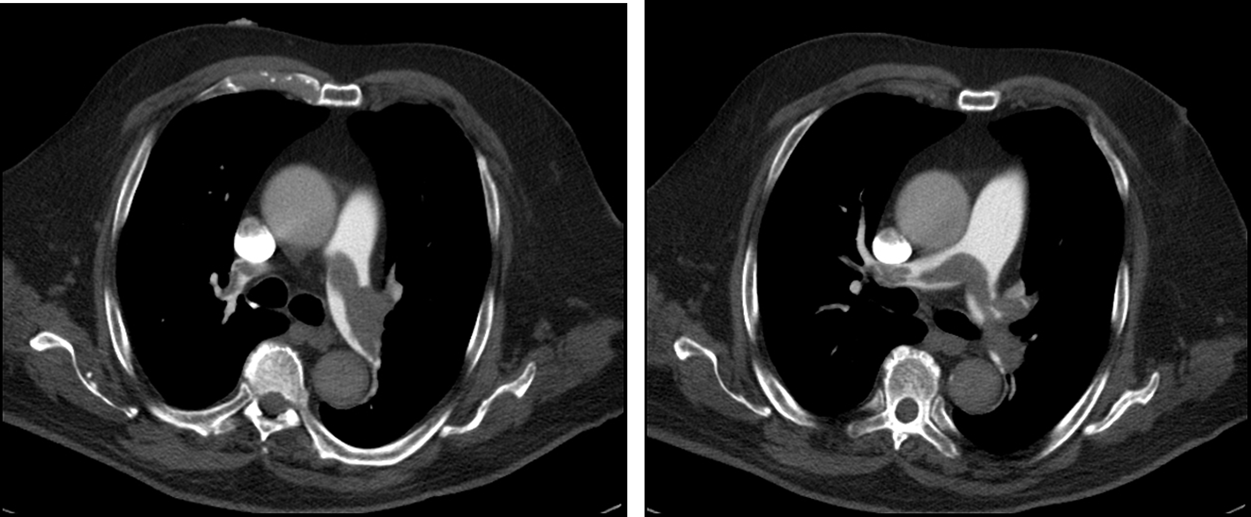 Angiogram scan showing two images