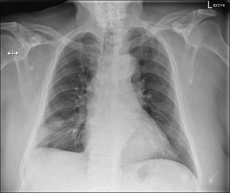 Chest x-ray