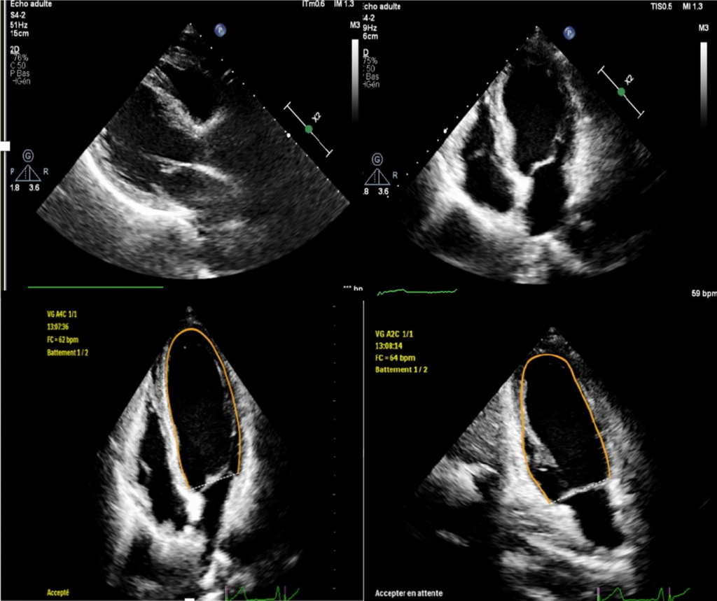 Echocardiogram scan with four images