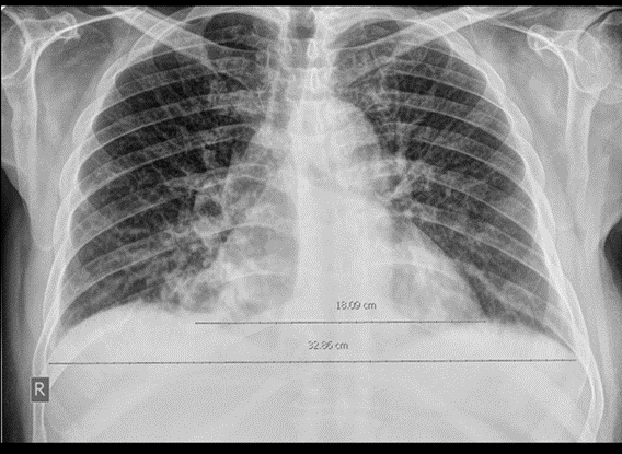 Chest x-ray