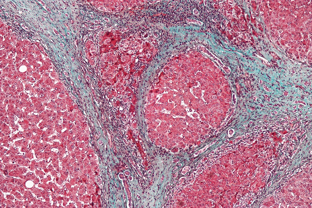 Liver biopsy tissue image