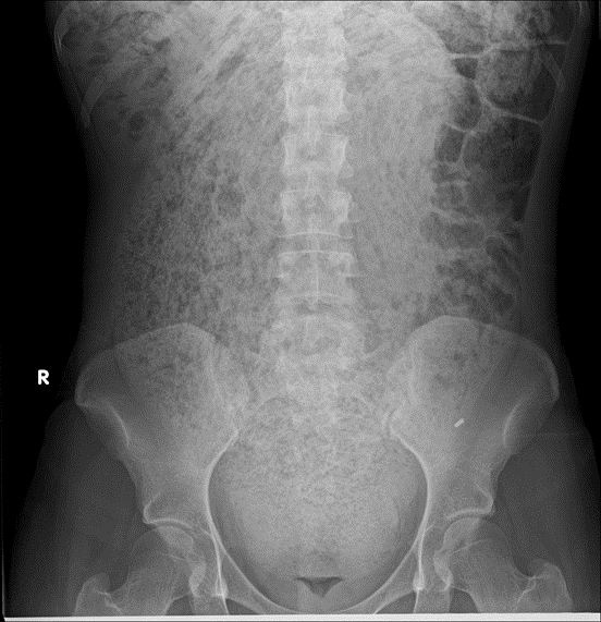 Abdominal x-ray