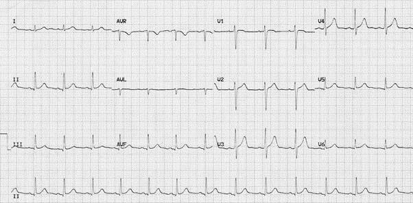 Facsimile of an ECG printout