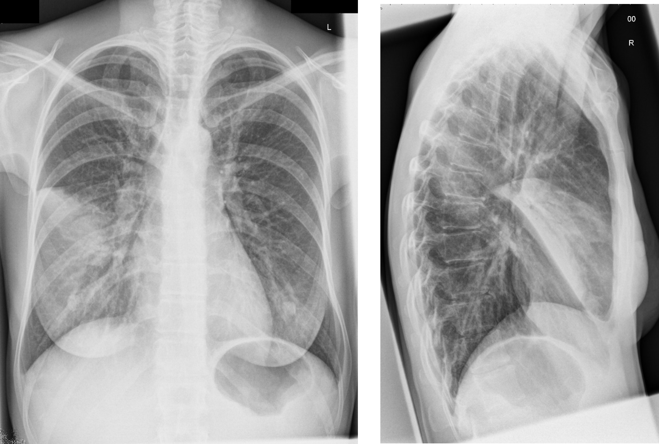 Chest x-ray images, one of front and one of side