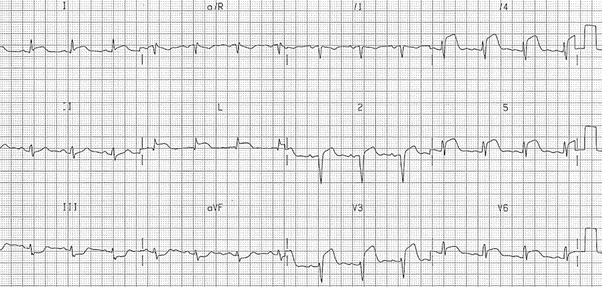 Facsimile of an ECG printout