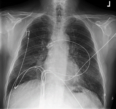 Chest x-ray