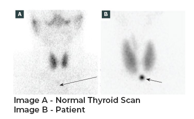 Two scan images of a thyroid scan. Image A is normal, Image B is a scan relating to the patient.